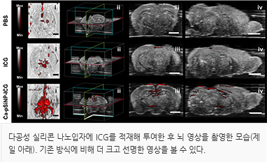 알츠하이머-02.jpg