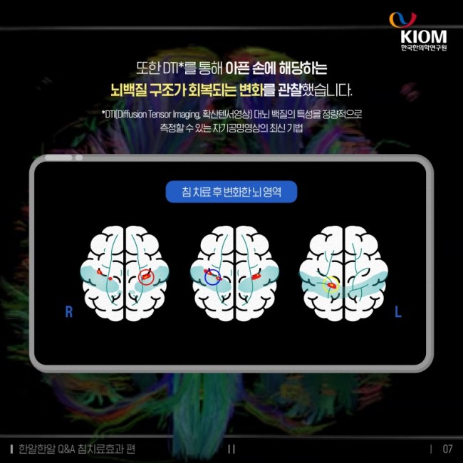 한알한알_QA_침치료효과-2차-07.jpg