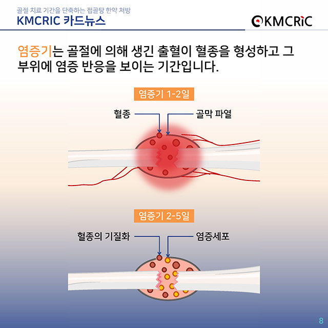 0072 cardnews-골절 치료 기간을 단축하는 접골탕 한약 처방-한글_페이지_08.jpg